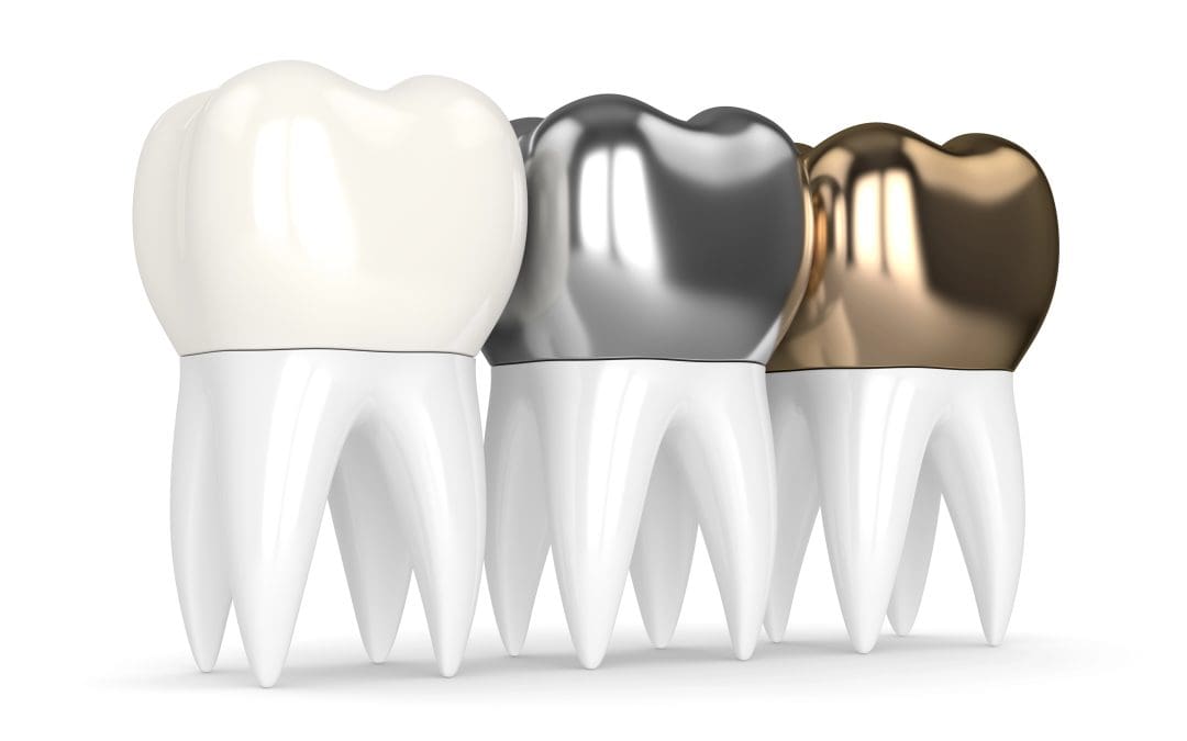 Same Day Crown for Chipped Tooth: Restore Your Tooth in a Single Visit