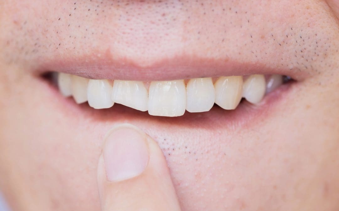 Cosmetic Dentistry for Chipped Teeth: Restore Shape and Symmetry with Ease