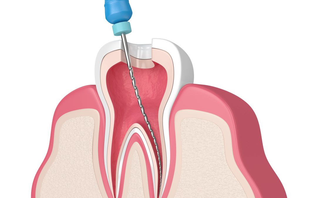 Expert Tips for Choosing the Best Root Canal Dentist in Aurora CO for Your Comfort and Care