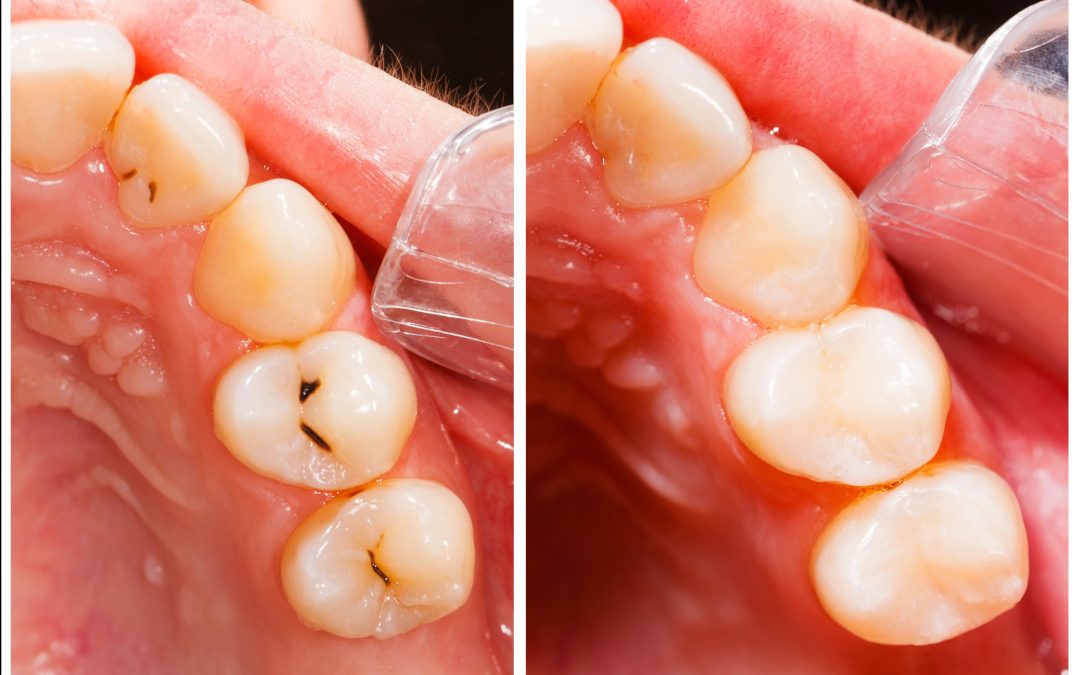 What to Expect During a Composite Dental Fillings Procedure in Aurora CO